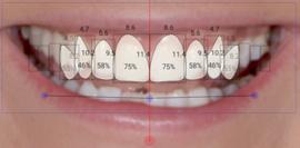 To resize all teeth simultaneously drag the blue rectangle around the teeth.