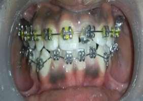 Orthodontic correction: Following orthodontic consultation, an initial treatment plan was formulated to gain the space of approximately 1 mm in maxillary and 1.