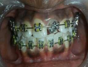 Because of the favourable response to treatment from the patient, no extractions were necessary. Full-fixed 0.022 slot MBT brackets were bonded on both the arches by the resin composite.