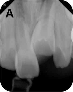 Angelman syndrome and was taking anticonvulsive medication. Clinical and radiographic examination revealed delayed eruption of the maxillary left central incisor (Fig. 1A).