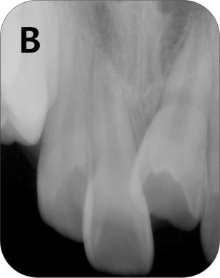 Radiographic examination demonstrated that his maxillary left central incisor had erupted slightly (Fig. 1B).