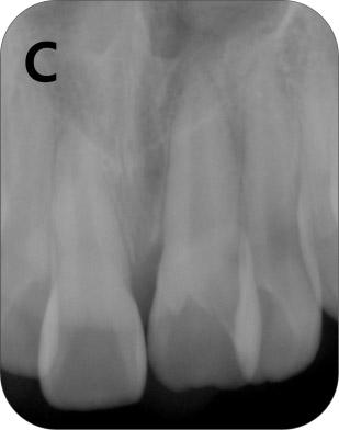 Eleven months after his second visit, at the age of 9 years and 10 months, the patient s parents brought him to our dental hospital because they had incidentally observed an unusual mass around the