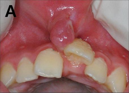 The swelling of the oral mucosa seen at the last visit became a pedunculated nodule measuring approximately 0.7 0.9 1.0 cm (Fig. 2A).