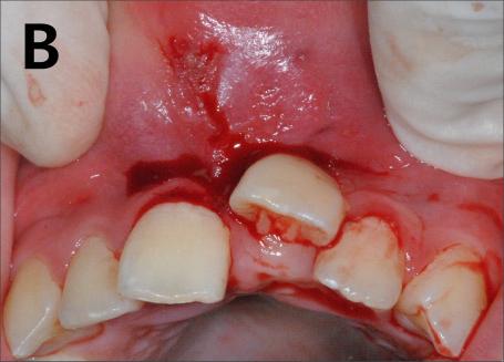 The patient had difficulty in closing his mouth completely due to the enlarged mass (Fig. 3).