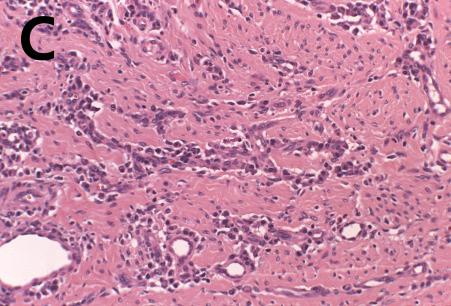 Dense bundles of collagen fibers, arranged in a circular pattern with vascular hyperplasia and infiltration of inflammatory cells, were observed in the underlying connective tissue.