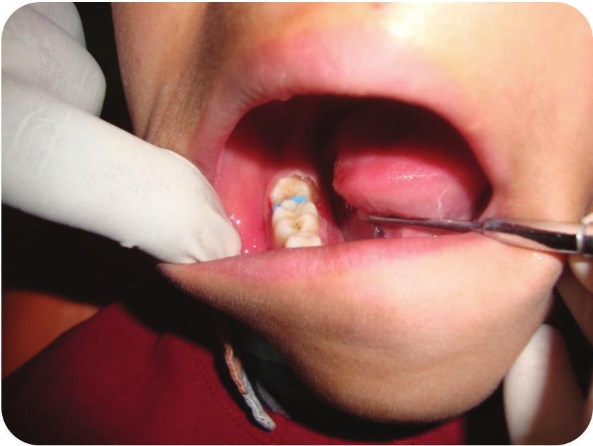 Clinical intraoral examinations revealed good oral hygiene with arrested caries in the right first permanent molar. The molar relationship was Angle class I on both sides.