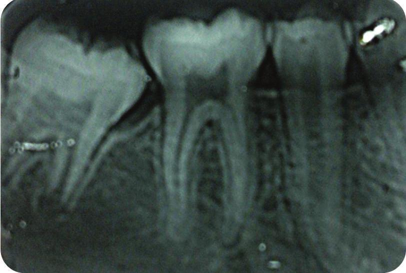Case Reports in Dentistry 3 Figure 5: Intraoral periapical radiograph after 3 days with elastic placed. region and discomfort brass wire, metal separators and deimpactor spring were not used.
