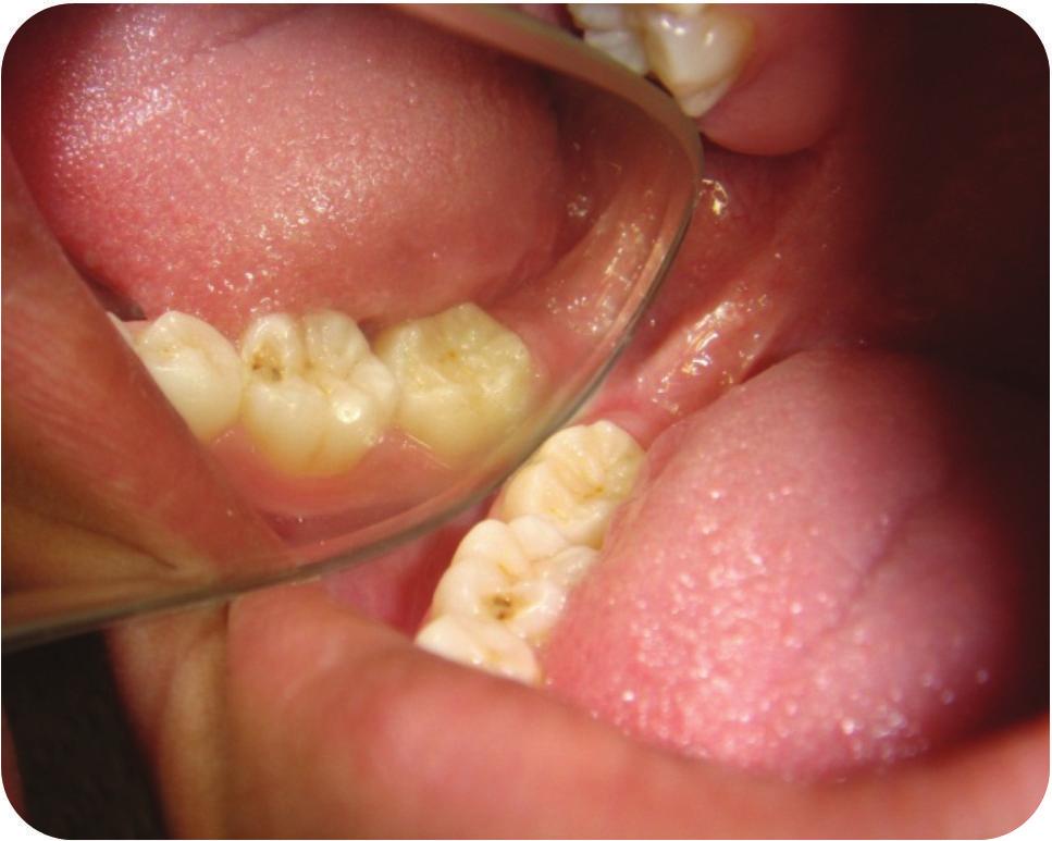 Gingival inflammation around the screws, poor oral hygiene, inapplicability in poor bone support areas, and treatment costs are the main disadvantages.