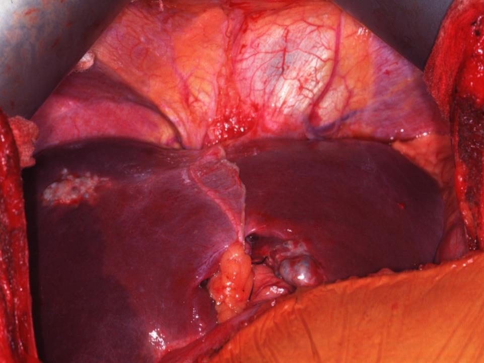 Colorectal Liver Metastases The liver is the major site of spread for colorectal cancer Patients without