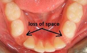 Early loss of a single primary canine: space maintenance or extraction of the contralateral tooth to eliminate