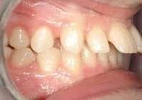 the habit should be eliminated before attempting to retract the incisors.