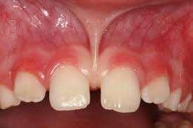 for larger diastema surgically removal of the frenal attachment may be necessary to obtain a stable closure of the midline diastema.