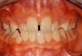 Anterior crossbite is rarely found in children who do not have a skeletal class III jaw relationship the maxillary lateral incisors tend to erupt to the lingual and may be trapped in
