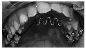 is a maxillary lingual arch with an anterior crib device it is