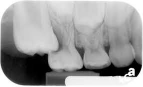 Ectopic eruption of permanent molars and canines the most common site is the maxillary molar region the second primary molar blocks the first permanent molar