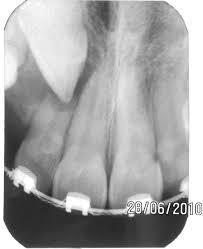 ectopic eruption of maxillary canine is relatively frequent it can