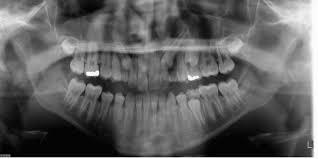 extract the maxillary primary canines when radiographs disclose that the permanent canines are overlapping