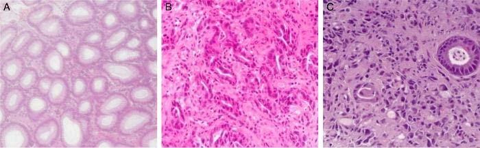 Pathology Lauren Classification Intestinal type Cohesive, forms glands Associated with atrophic gastritis