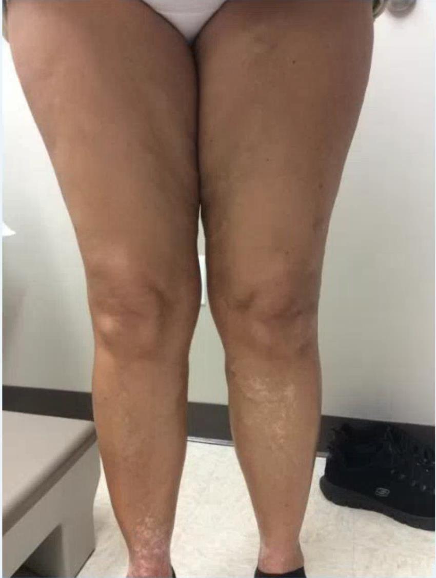 A 70 year-old female presents with symptomatic varicose veins on left leg for