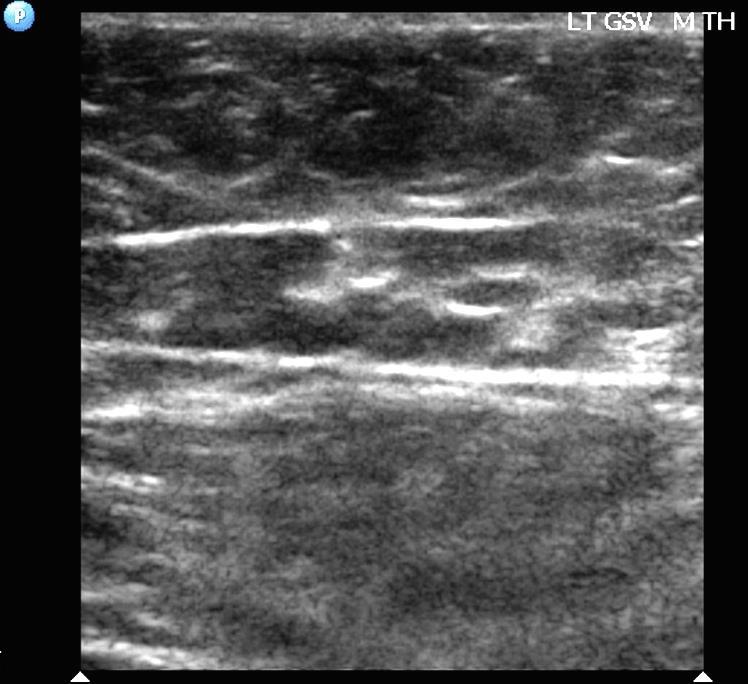 GSV thigh hypoplasia with reflux