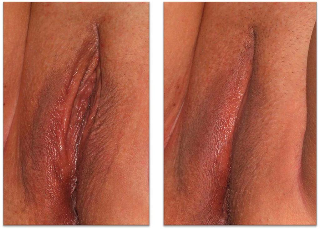 VANAMAN WILSON ET AL Figure 3. A 48-year-old subject rated by investigators as (left) moderate laxity (3) at baseline and (right) no laxity (0) at Day 120.