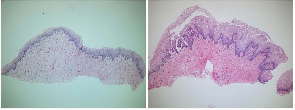VANAMAN WILSON ET AL Figure 6. Histology of the vaginal canal mucosa before (left) and at Day 120 after (right) treatment with TTCRF.