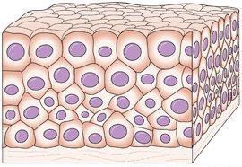 carcinoma Glandular cells e.