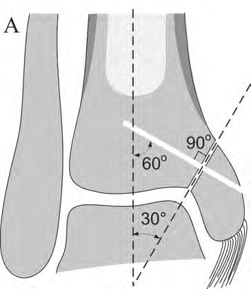 Direction of the medial malleolar osteotomy 11 CI = 95% confidence interval. Figure 1.
