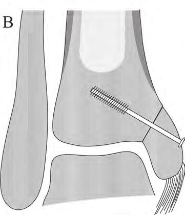 (1) Transverse osteotomy; (2) Oblique osteotomy; (3a) Step-cut osteotomy; (3b) Modified step-cut osteotomy; (4) Crescentic osteotomy; (5) Inverted U-osteotomy; (6) Inverted V-osteotomy. Figure 2.