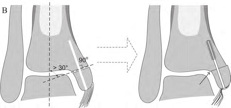 between the tibial plafond and the articular facet of the medial malleolus.