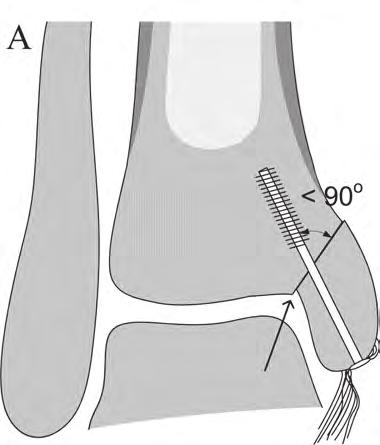 Direction of the medial malleolar osteotomy 11 Figure 4. Schematic drawing showing the importance of the direction of fixation screws.
