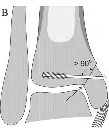 Even when the osteotomy is performed correctly, a rather vertical (A) or horizontal (B) insertion of the screws may result in an incongruent joint surface after reduction (arrows).