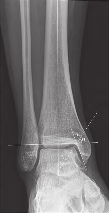 approximately half of the lower leg proximally (Figure 5). The radiographs (4.
