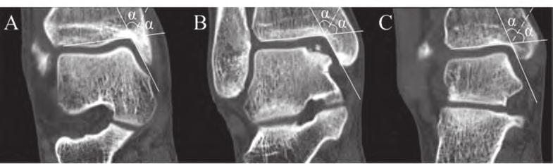 Direction of the medial malleolar osteotomy 11 Figure 6.