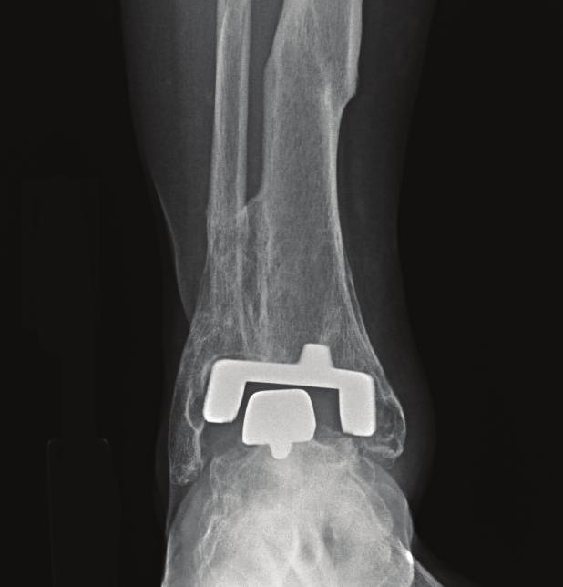 Examination and Radiography Twelve years after her ankle replacement surgery, the patient returned for re-evaluation due to increasing pain.