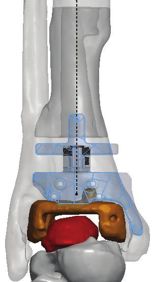 Additional pins were placed prophylactically in each malleolus to aid in fracture prevention, as the malleoli were thin due