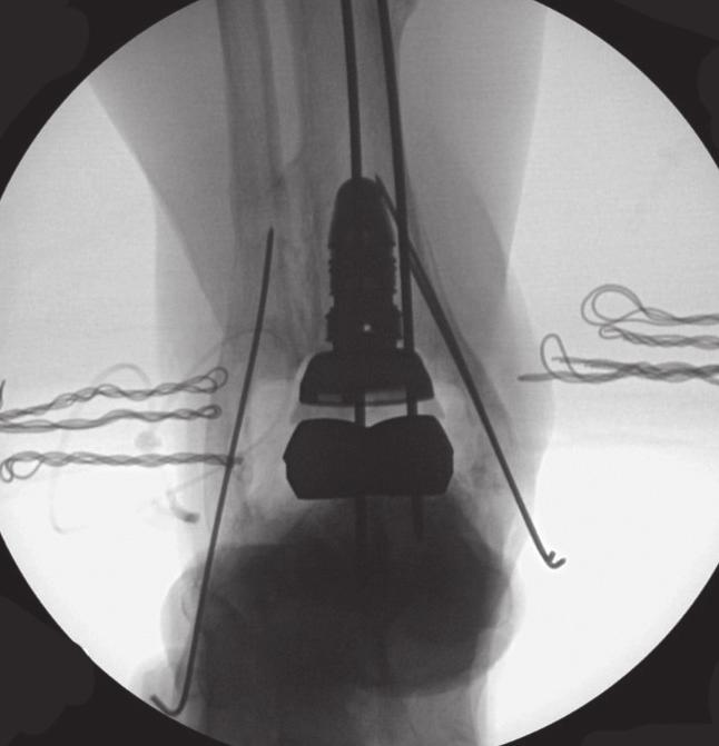 tibial prosthesis (INBONE).