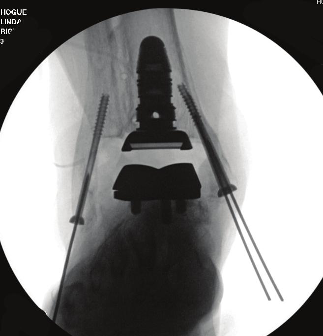 To reduce the risk of postoperative malleolar fracture, cannulated