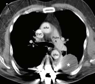 Figure 2 shows a chest X-ray and corresponding CT scan showing a loculated and benign pleural effusion.