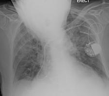 CXR showing a right superior mediastinal mass (black arrows) at the level of the