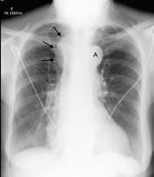 CT chest with oral contrast of the same patient as figure 3 showing dense oral