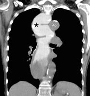 Note that the aorta (Ao) is not opacified as this CT has been performed without