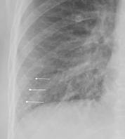 CXR (magnified) showing Kerley lines due to abnormal fluid in the peripheral