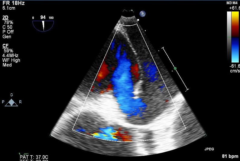 Trans-oesophageal Echocardiogram Colour flow Doppler demonstrating