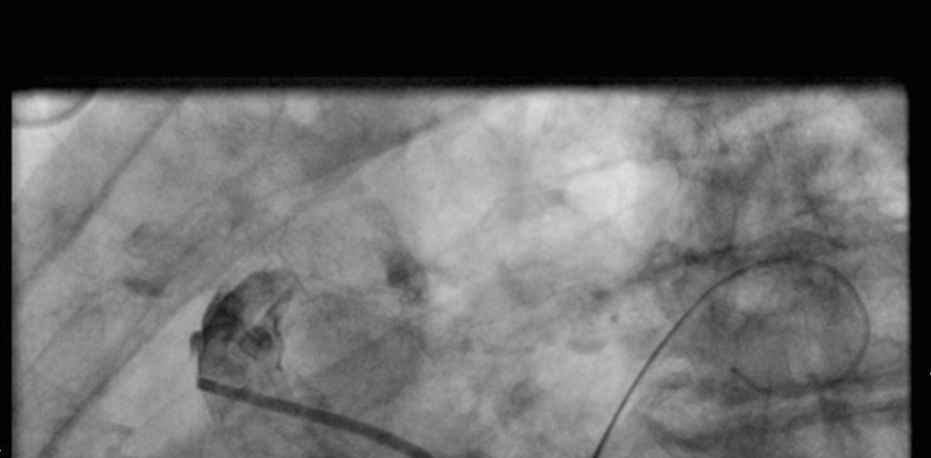 Right heart catheterisation demonstrating Atrial Septal Defect