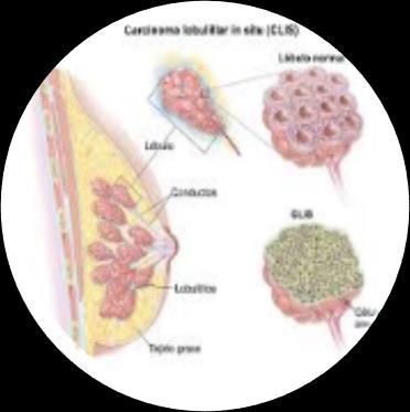 Lobular carcinoma starts in parts of