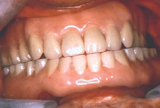 Morrow et al7 in 1969 published a notable paper which described the benefits of keeping roots as overdenture abutments and described the concept as "preventive prosthodontics.