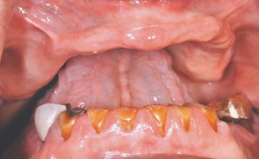 FIGURE 4. This 65 year old female has been wearing a complete maxillary denture and a removable partial overdenture for 12 years.