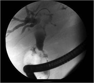 diagnosis/staging ERCP favored over MRCP for stenting and