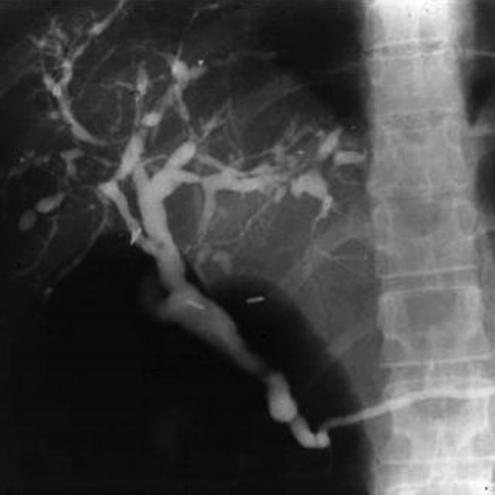 ducts Intrahepatic Extrahepatic Small duct variant Radiographic